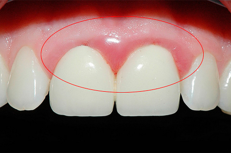 Что делать если шатается постоянный зуб: советы стоматолога