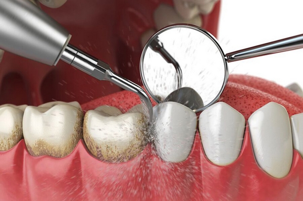 Что такое зубной камень, когда и как его удалять?