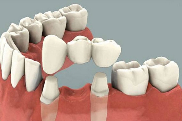 Зубные коронки: самое доступное протезирование
