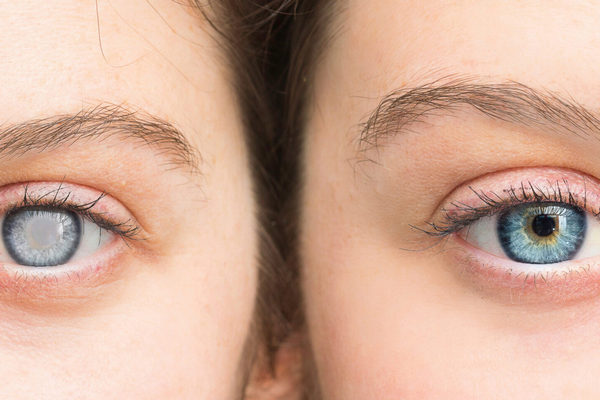 Одномоментное лечение катаракты и глаукомы