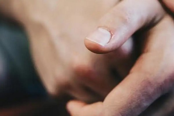 Три признака дефицита железа: посмотрите на свои ногти