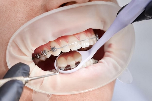 Особливості вибору стоматологічних товарів для ізоляції та адгезії