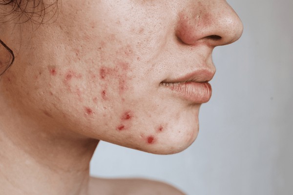 Когда прыщи на подбородке — сигнал к врачу: Диагностика гормонального акне.