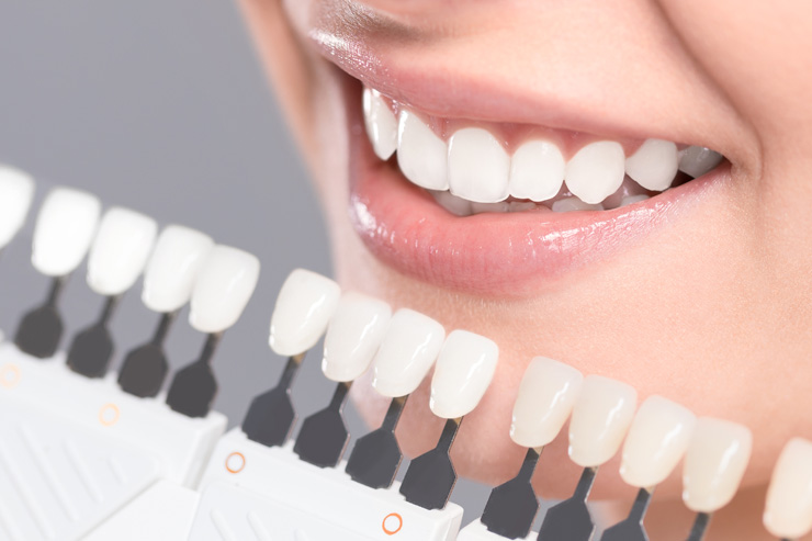 Отбеливание зубов: в клинике и дома