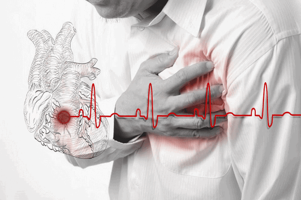 Что такое инфаркт миокарда?