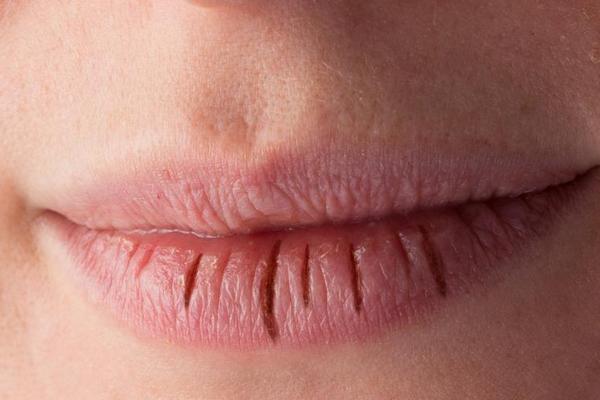 Трещины на губах, тонкие брови: о каких болезнях говорят следы на нашем лице